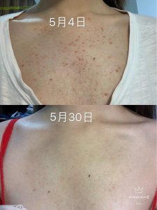 胸口长痘长篇预警！一定要认真看完！