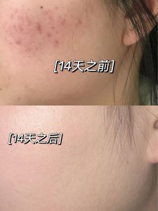 真有祛痘印神器吖！我现在才发现这宝贝儿
