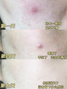 万痘皆可灭祛豆小灰瓶我爱了科学祛痘