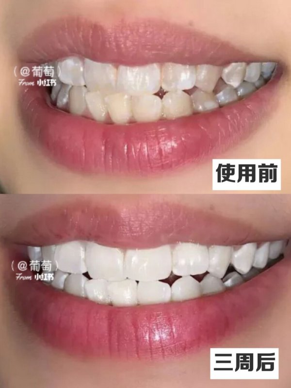 身边隔三差五有人问我，美白伤牙吗？哪种美白方式好？