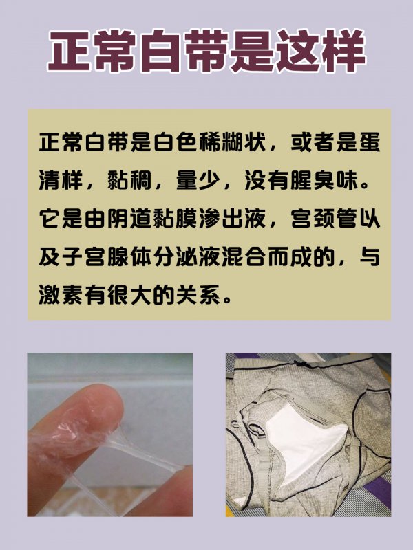 妇科炎症太可怕了你的白带正常吗63