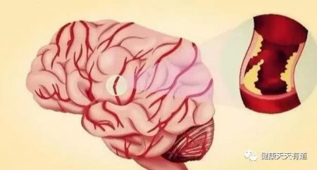 脑梗救星找到了 水里常泡点 清血管降血脂 大脑更健康