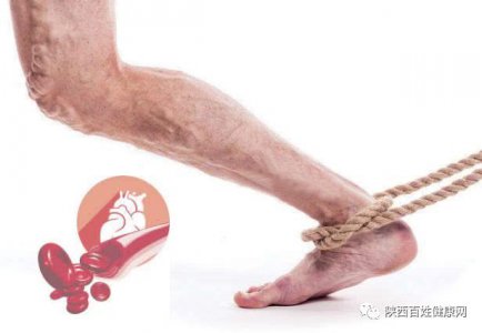 静脉血栓：一分预防大于十分治疗 | 陕西黎民健康专栏