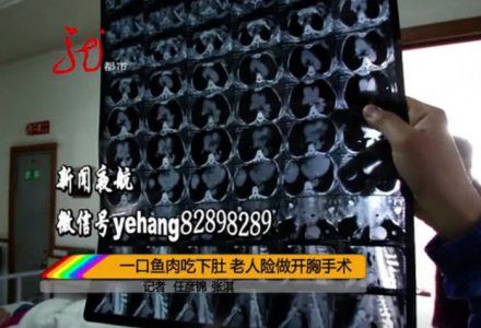 一口鱼肉吃下肚 却被鱼刺卡住 吃馒头、吃芹菜 都不管用 哈工大附属黑龙江省