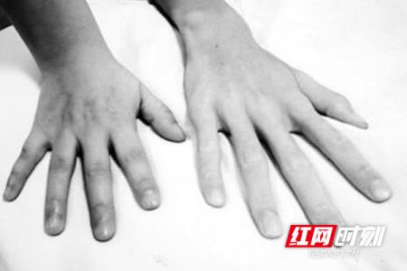 株洲：一家五口患罕见遗传病 医生为蜘蛛人做救心手术