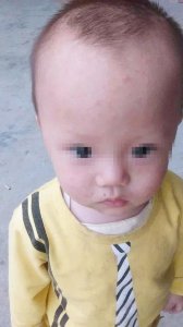这种食物引发多起儿童贫血症 孩子再喜欢也不能给他吃