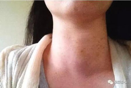 为何甲状腺癌患者 一年比一年多？或许是没能绕开它