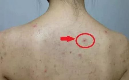 身上有湿气重怎么办 3个小妙招逼出体内湿气