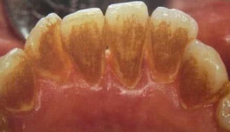 牙齿上粘着小石子 抠出来异臭难闻 你有过吗？