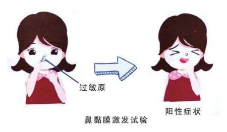 确定过敏原 激发试验是最正确的方法之一