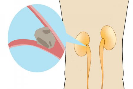 肾结石患者饮食要注意什么？若不想加重病情 几类食物少碰为妙