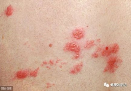 荨麻疹经常引起 适当护理 以及生活日常照顾