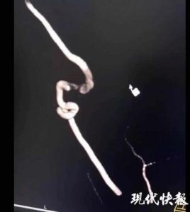 不懂推拿别乱按 女子好心帮助却诱发同事脑梗死