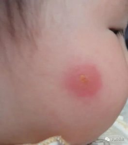 宝宝被蚊虫叮咬后该怎么办？