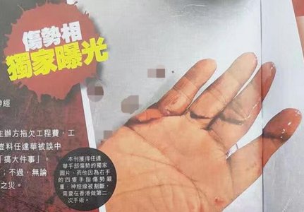 任达华右手伤口首曝光 右手指齐齐被割伤非常严重