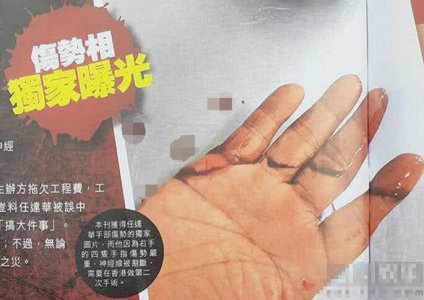 任达华右手伤口曝光 四指被割很深的伤口触目惊心