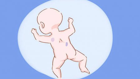 宝宝长胎记的4个原因 大多与孕妈有关