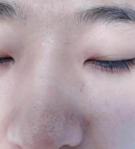 去黑头的撕拉面膜 去黑头的撕拉面膜管用吗？