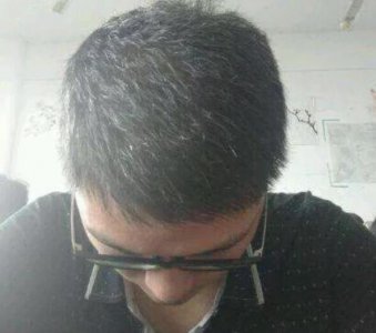 现在少白头这种情况真的是太普遍了 少白头经常染发的人好不好？