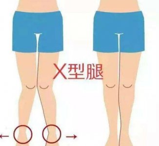 当人们发现自己是x型腿时 x型腿怎么矫正的方法？