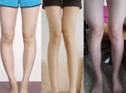 很多女孩都有腿粗的烦恼 O型腿怎么矫正方法？