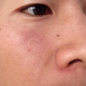 女孩子都想要一个好的皮肤 脸部皮肤毛孔太大怎么办？