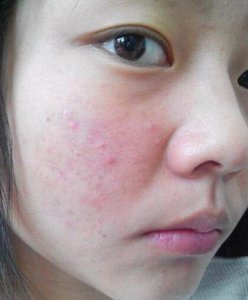 在我们都还在青春期的时候 怎样去脸上的痘痘和痘印？