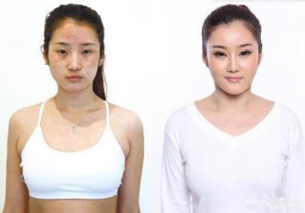 我之前因为夏天的时候没有防晒 怎样彻底去除黄褐斑小窍门？