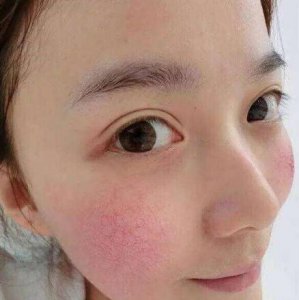 红血丝主要是因为面部毛细血管分布太浅 脸上出现红血丝是怎么回事？