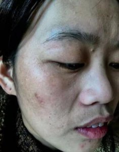 每个小仙女都希望自己一直拥有洁白无瑕的肌肤 脸上为什么长斑的原因 怎么去