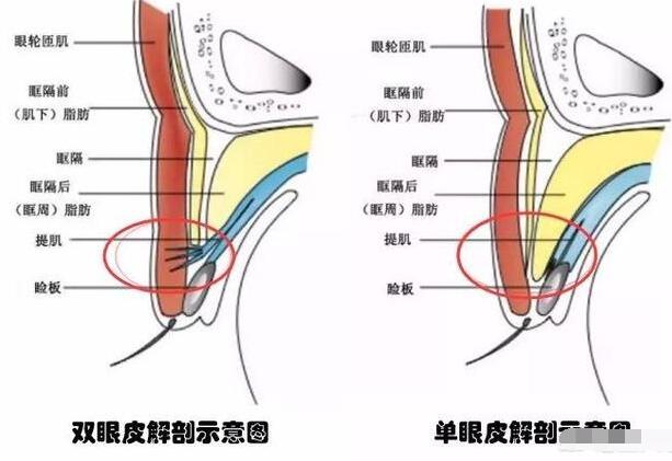 单眼皮和双眼皮的解剖结构