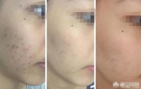 痘痘是常见的慢性皮肤病 脸上长痘痘用什么药好得快
