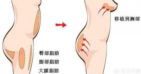 脂肪丰胸影 脂肪丰胸影响哺乳吗？