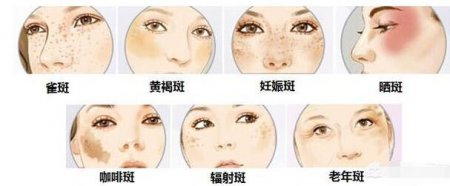 斑点也分好多种的 脸上有斑怎样才能祛斑？