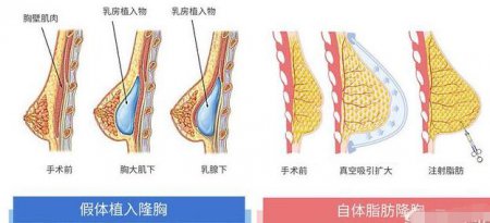 隆胸 隆胸都是什么填充物？
