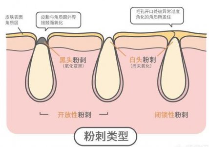 黑头 黑头是怎么形成的原因？怎么避免长黑头