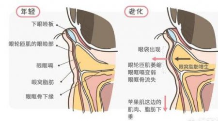 眼袋怎么消除 眼袋怎么消除简单方法有哪些