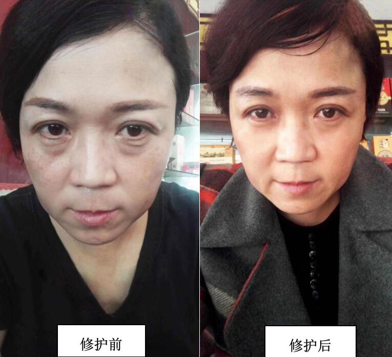 秦雨笔记-我今年42岁 有眼袋了怎么办啊 怎么消除呢 有哪些办法