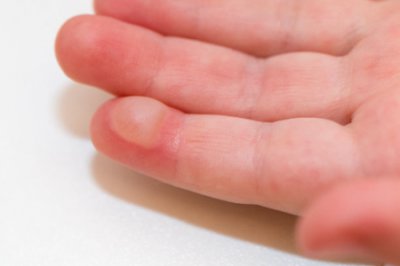 烫伤后怎么处理 三个方法急救缓解痛苦