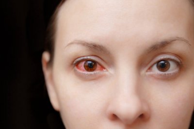 红眼病症状表现有哪些？三个结膜炎症状带来伤害表现
