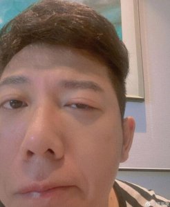 胡海泉右眼发炎红肿 吃力半睁右眼尽显疲惫十足