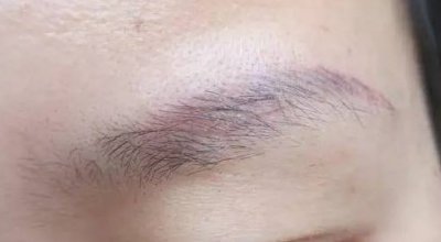 激光洗眉多久恢复 洗眉后注意事项有哪些