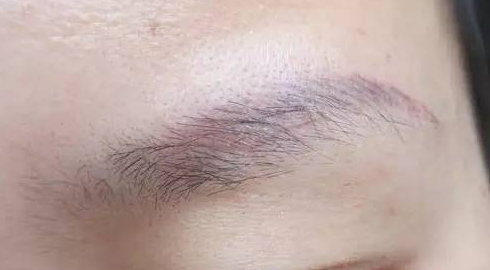 激光洗眉多久恢复洗眉后注意事项有哪些