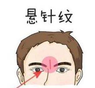 什么是悬针纹悬针纹怎么去除小偏方
