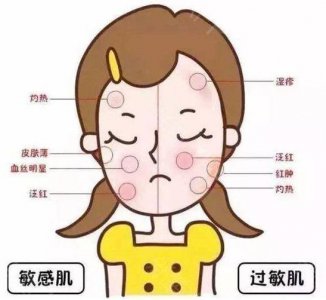 红敏肌自己怎么改善