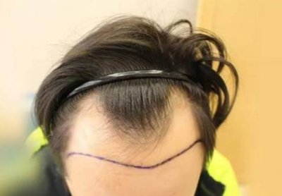M型发际线和脱发有区别吗 正常m型发际线是怎么样的