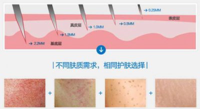 微针的功效 微针是什么