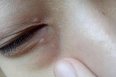 脂肪粒怎么消除在眼睛旁边的？四个眼部脂肪粒去除方法