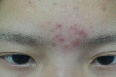 眉心长痘痘是什么原因？三个造成女人眉心长痘痘的原因