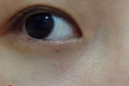 脂肪粒是怎么形成的？如何预防脂肪粒的产生